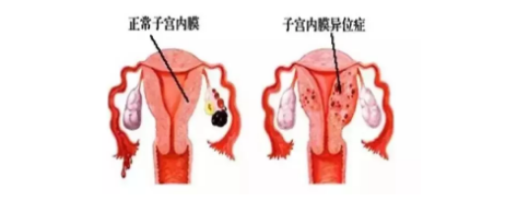 痛經(jīng)可不只是痛那么簡單，可能隱藏哪些婦科疾患