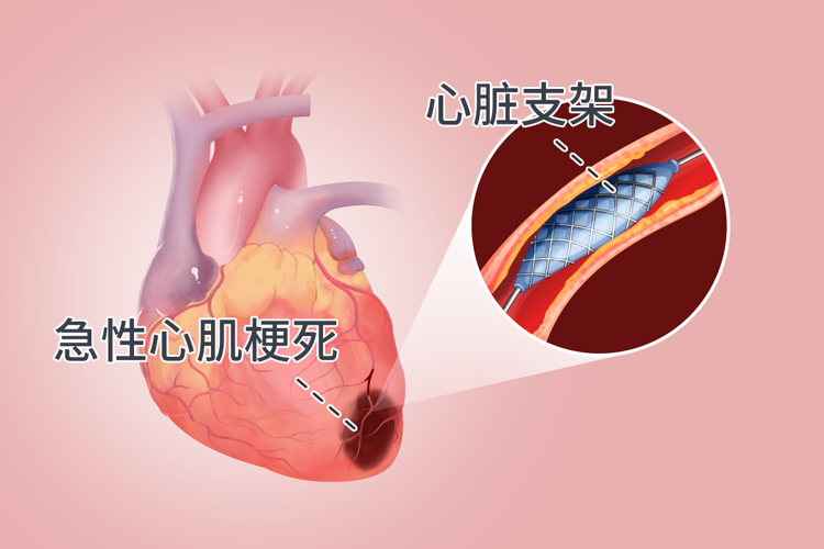 心臟支架手術：到底是治病救人還是“缺德害人”？告訴你真相